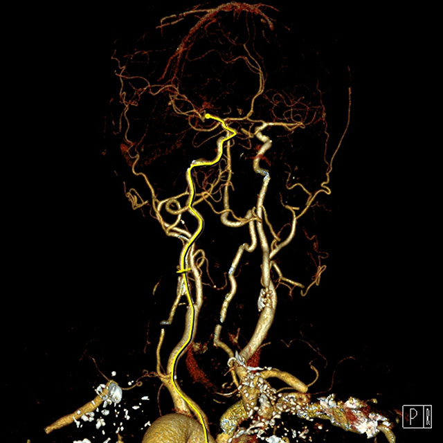 Medical image scan shows arteries supplying the brain on computed tomography angiography in a patient with carotid artery disease.