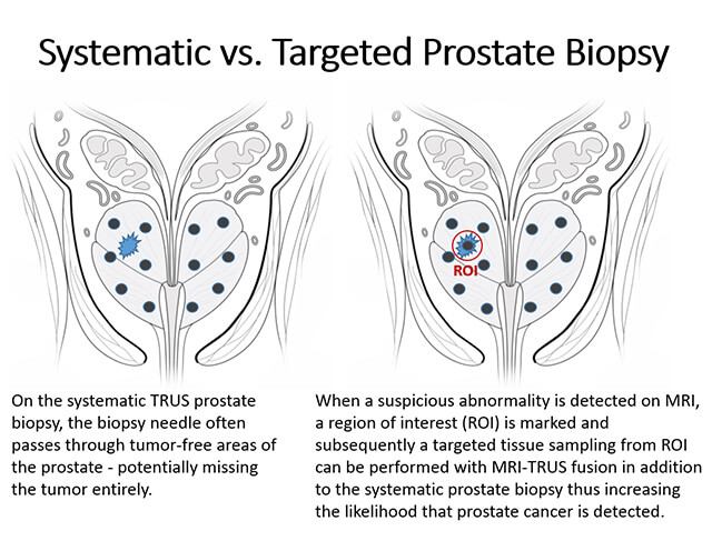 Dont get a prostate biopsy