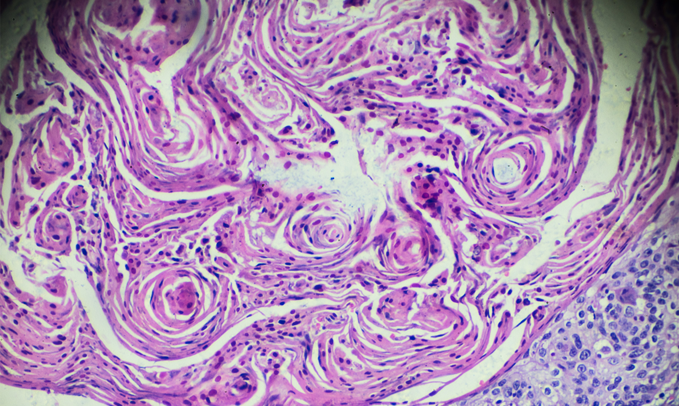 Cervical cancer viewed under light microscopy