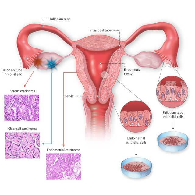 A depiction of the anatomical locations of gynecologic cancers.