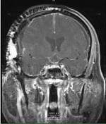 post-op coronal craniopharyngioma (pituitary tumor)