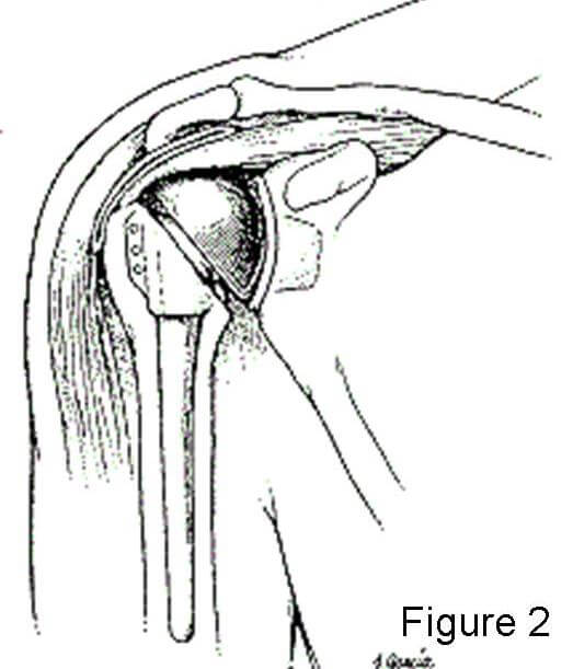 Diagram of a reverse shoulder replacement. Described under the heading What are these shoulder replacements called a reverse prosthesis