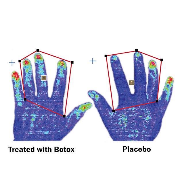 Image shows laser Doppler imaging of blood flow to hand after treatment with Botox next to placebo