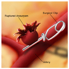 Microsurgical clipping for brain aneurysms