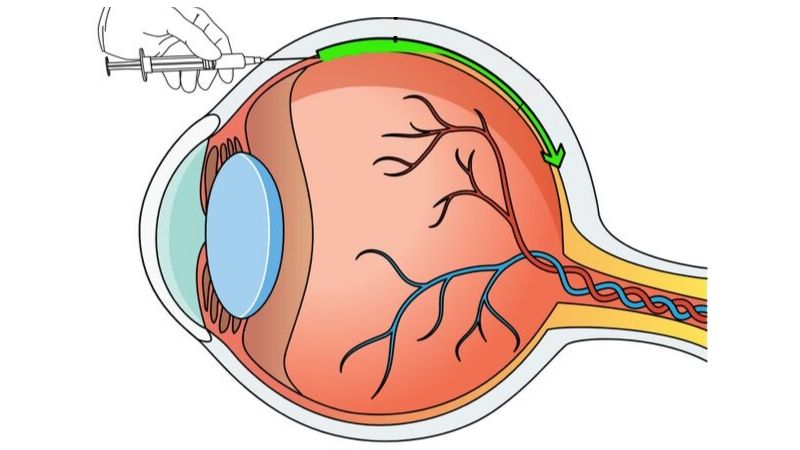 Newswise: Johns Hopkins Researchers Advance Search For Safer, Easier Way to Deliver Vision-Saving Gene Therapy to The Retina