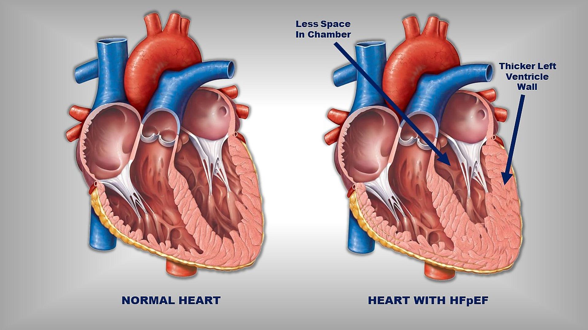 Research Story Tip: Obesity Weakens Heart Muscle in Patients with a Common  Type of Heart Failure