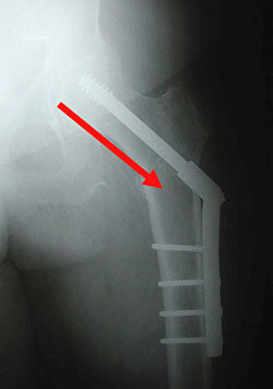 sliding hip screw
