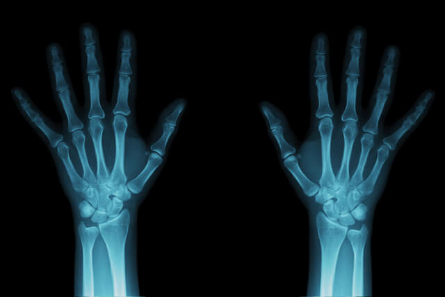 Imaging of hand bones