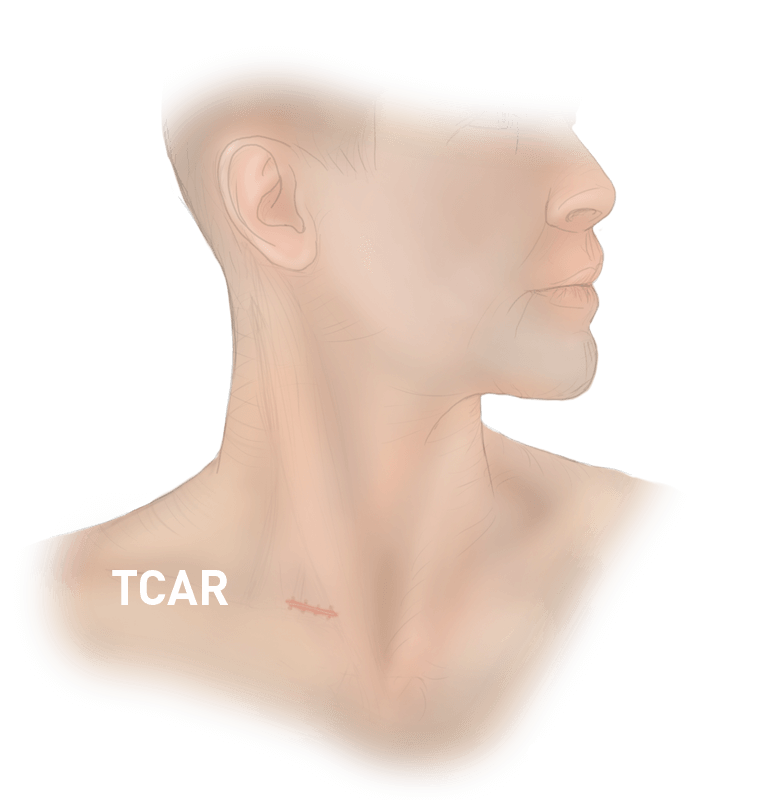 TCAR Scar
