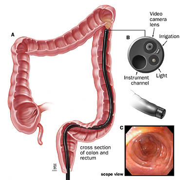 A: Position of the sigmoidoscope in the colon; B: endoscopic view; C: detail of the colonoscope tip.