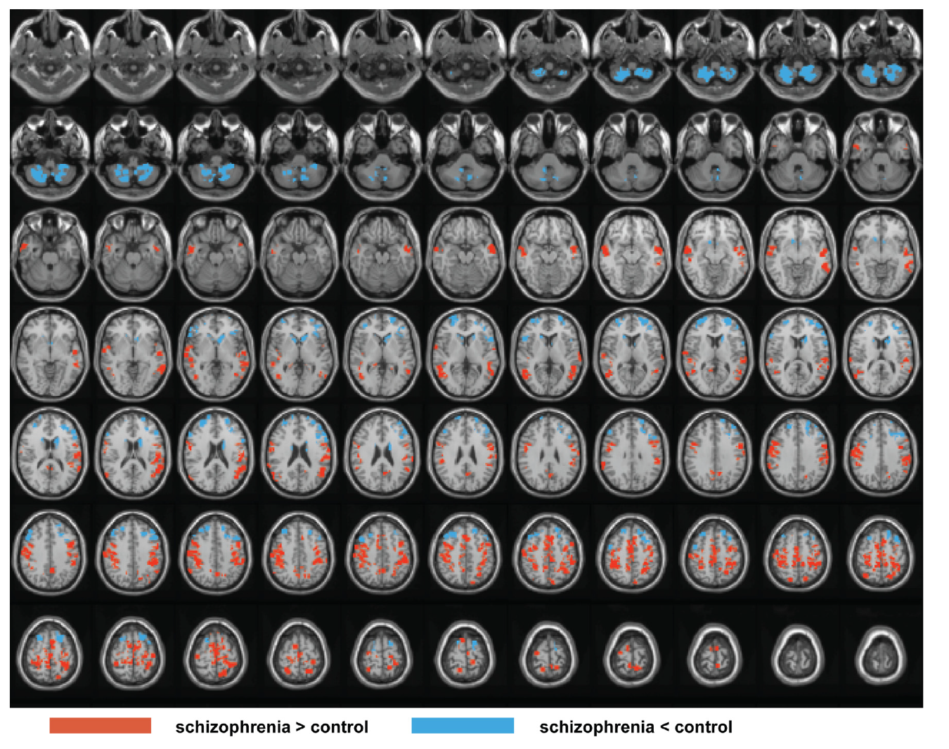 Map of resting state thalamic functional connectivity in schizophrenia vs control patient