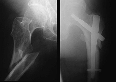 intramedullary hip screw