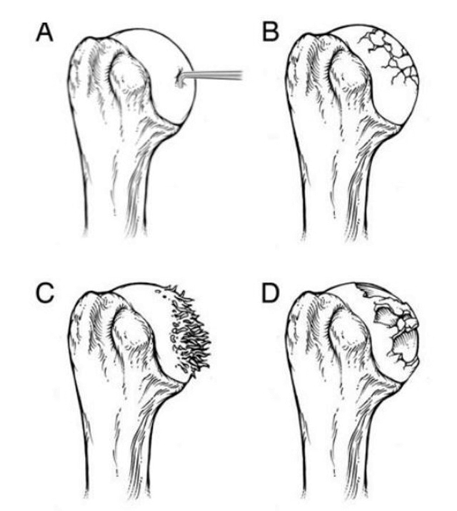 Four stages of shoulder arthritis