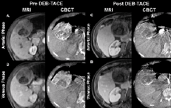 CT scans of a liver tumor before and after chemoembolization.