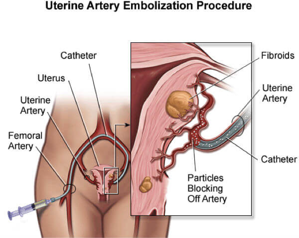 illustration showing uterine artery embolization