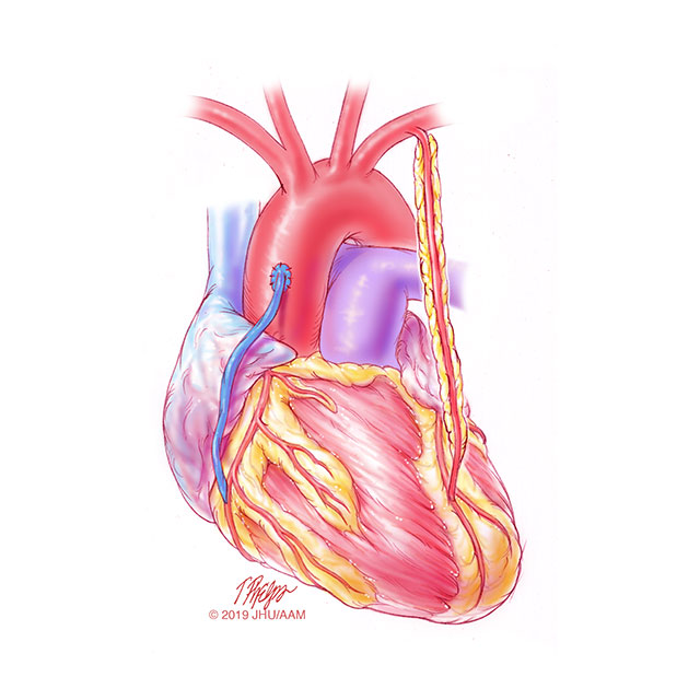 Illustration of human heart shows two methods of coronary artery bypass using a saphenous vein graft or the left internal mammary artery graft. 