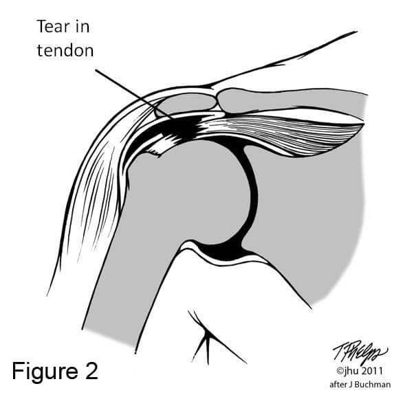 Shoulder diagram showing a torn rotator cuff tendon