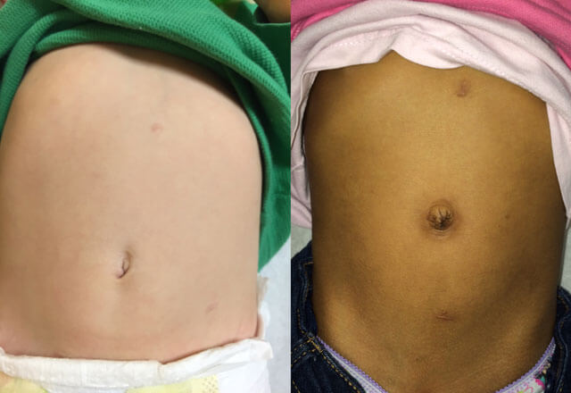 children's abdominal scars heal from robotic surgery