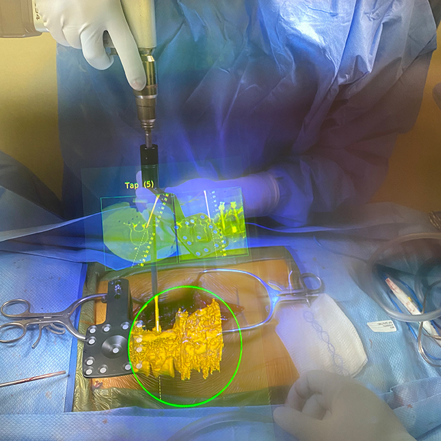 Photo shows surgeon's operating view using augmented reality to superimpose medical scans and data in field of vision above patient's open surgical site.