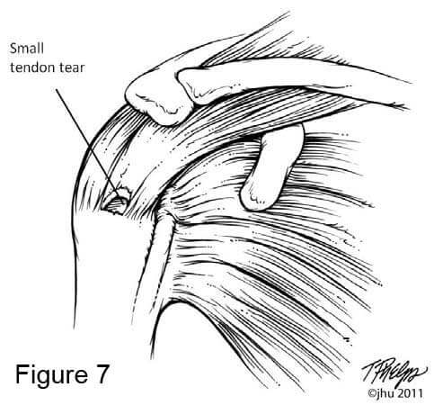 Shoulder diagram showing small rotator cuff tear