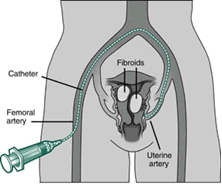 Picture of uterus with blood supply to the fibroids.  Notice the catheter is placed directly into the blood supply of the uterus.  (Courtesy of SCVIR, www.scvir.org)