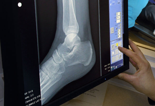 x-ray of an ankle