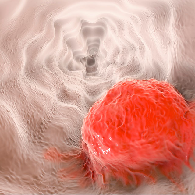 3D illustration showing tumor on the wall of the esophagus