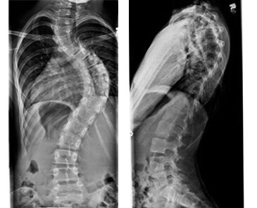xrays of maggie's spine before surgery