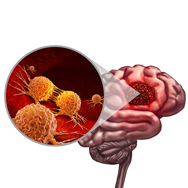 A medical illustration of brain cancer