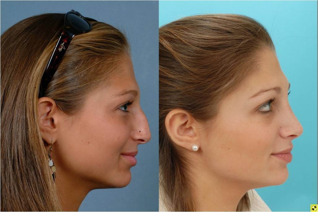 Rhinoplasty Johns Hopkins Facial Plastic and Reconstructive Surgery