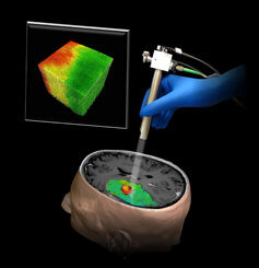 a new technique using optical coherence tomography