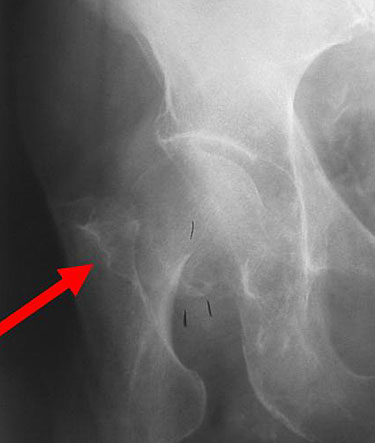 Unstable femoral neck fractures