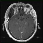 post-op axial craniopharyngioma (pituitary tumor)