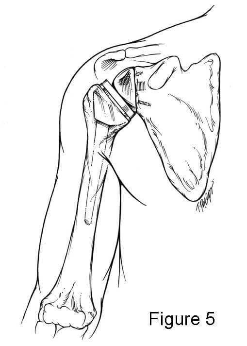 Diagram of shoulder movement after reverse shoulder replacement. Described under the heading How does it stay together?