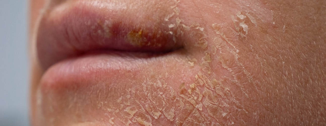 Man with scaly, flaky skin around his face