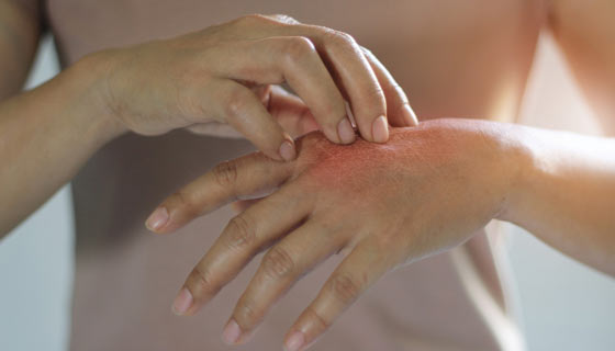 Woman scratching itchy, scaly skin on her hand